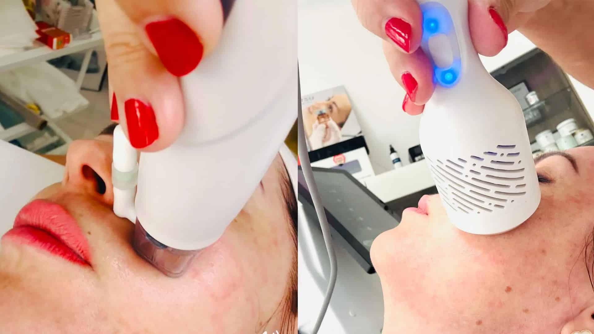 Mikrotűs rádiófrekvenciás kezelés Dr. Fábiánné Erdődy Noémi szalonjában